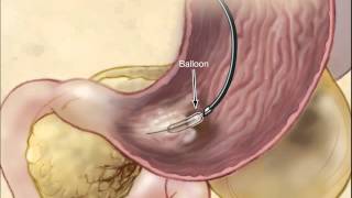 Infected Necrotizing Pancreatitis  Treatment By Endoscopic Transgastric Necrosectomy [upl. by Ranzini171]