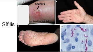 Sífilis Etapas de la infección diagnóstico y tratamiento [upl. by Mixie]