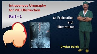 IVU for PUJ Obstruction Part 1 [upl. by Camilo]