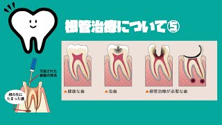 根管治療が必要な症状 根管治療について5 [upl. by Kcinimod]