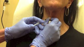 Botox for Platysmal Bands on Neck [upl. by Nosde]