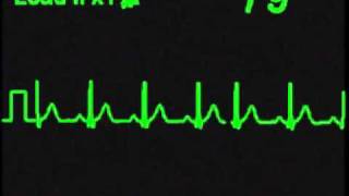 Normal Sinus Rhythm  NSR  ECG Simulator  Arrhythmia Simulator [upl. by Beacham554]