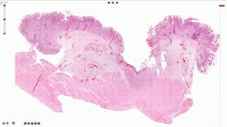 Peptic Ulcer  Histopathology [upl. by Claire]