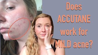 My Accutane Experience MILD persistent acne [upl. by Winthrop]