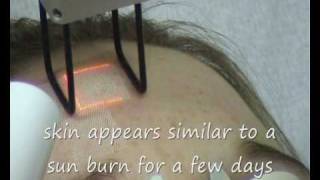 Fractional CO2 laser treatment Norwich Norfolk UK [upl. by Yrocej825]