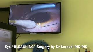 Eye Bleaching Surgery for Racial Melanosis Dr Ebbie Soroudi MD MS [upl. by Almeta]