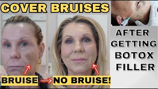 Cover Up a Bruise With Makeup Getting Injectables Often Causes Bruising Heres an Easy Fix [upl. by Herzig488]