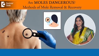 Are skin moles dangerous Know about the 5 methods for Mole RemovalDr Vandhana MDoctors Circle [upl. by Newnorb798]