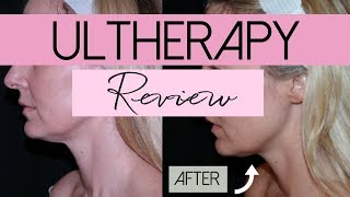 Ultherapy  NonInvasive Face Lift Treatment  Review  BusbeeStyle TV [upl. by Shig]