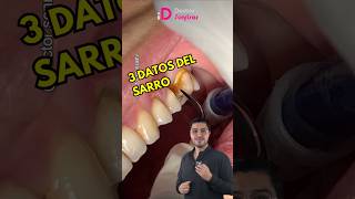 Sarro en los dientes limpiezadental dientesperfectos dientesperfectos shorts dentista [upl. by Nireil169]