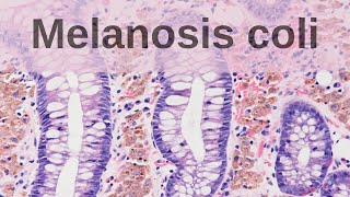 What is Melanosis Coli  Pathology mini tutorial [upl. by Htomit]