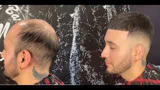 From Bald to Full Head of Hair by mickeydabarber I Hair Unit [upl. by Jordon652]