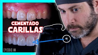 👉COMO se ponen las 𝘾𝘼𝙍𝙄𝙇𝙇𝘼𝙎 𝙙𝙚 𝙋𝙊𝙍𝘾𝙀𝙇𝘼𝙉𝘼 en los dientes Te lo explico FÁCIL  COMPRUEBALO✅ [upl. by Li164]