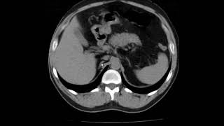 Agenesia renal unilateral [upl. by Llehcear]