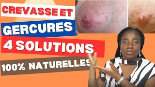 Comment Prevenir et Guerir les Grevasses et les Gercures [upl. by Jolynn558]