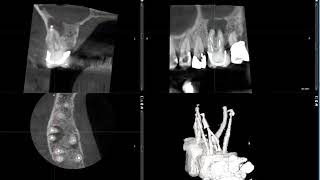 Persistent apical periodontitis 3 [upl. by Airrej59]