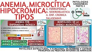 ANEMIA MICROCÍTICA HIPOCRÓMICA TIPOS  GuiaMed [upl. by Livvi]