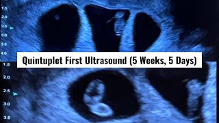 Our First Ultrasound at 5 Weeks amp 5 Days Its Five Finding Out We Were Having Quintuplets [upl. by Cantu543]