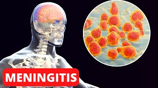 La MENINGITIS explicada síntomas tipos causas consecuencias tratamiento [upl. by Gilus304]