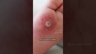 Skin Tags 3 Major Causes amp Proper Removal Tips You Need to Know  DrShwetha Rahul [upl. by Rhyne]