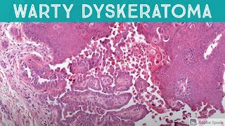 Warty Dyskeratoma acantholytic dyskeratosis patterndermatology pathology dermatopathology [upl. by Ahsilam250]