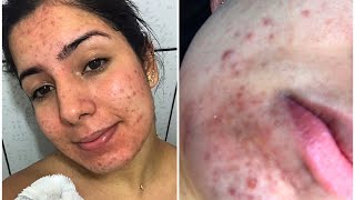 TRATAMENTO DE ACNE Meciclinepiduogel e episol [upl. by Heller117]