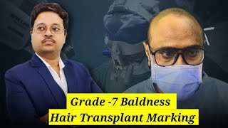 Grade 7 Bladness  Hair Transplant Planning amp Marking  Bain clinic Kolkata [upl. by Hwu]