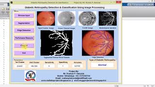 Matlab Code For Diabetic Retinopathy Detection in Fundus Image Using Image Processing [upl. by Anne-Marie756]