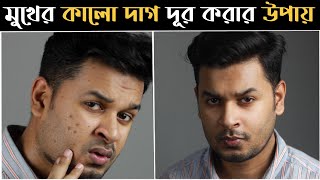 মুখের কালো দাগ সহজে দূর করার উপায় । How to Remove Dark Spots Naturally । কালো দাগ । ব্রনের দাগ [upl. by Anaul188]