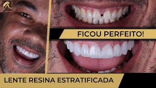 FECHAMENTO DE DIASTEMA EM UMA ÚNICA SESSÃO [upl. by Adierf]