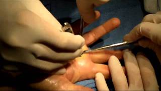 Trigger Finger Release with Cyst Excision [upl. by Eibocaj309]