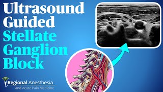 Ultrasound guided stellate ganglion block [upl. by Aciretnahs]