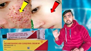 Betnovate  C Skin Cream लगाने का सही तरीका  Acne Removal Skin Care [upl. by Ervin]