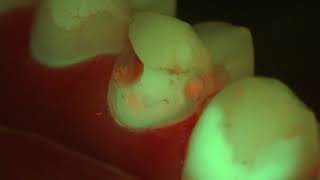 Real time Caries Diagnosis using Zeiss Extaro 300 in Fluorescence Mode [upl. by Lonni]