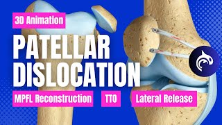 How Its Fixed  Patellar Dislocation MPFL Repair Tibial Tubercle Osteotomy and Lateral Release [upl. by Adnola]