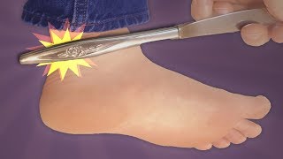 The Ankle Sign of Hypothyroidism [upl. by Atiker53]