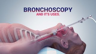 BRONCHOSCOPY  ITS USES I DR NAVEEN KUMAR AILAWADI I CHEST SPECIALIST [upl. by Bertero]