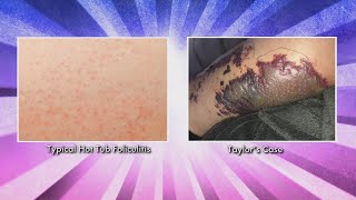 What Puts You at Risk for Hot Tub Folliculitis [upl. by Ottinger846]