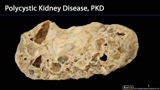 Respiratory and Urinary Station 12  Renal Pathologies and Developmental Abnormalities [upl. by Navannod]