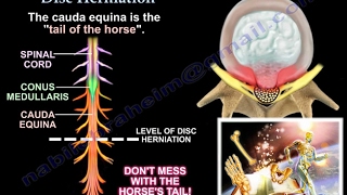 Treatment of herniated disc with TESSYS method lateral  BandscheibenOP mit TESSYSMethode lateral [upl. by Cown17]