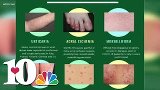 Doctor Skin rash could be a symptom as possible COVID19 symptom [upl. by Aivin359]