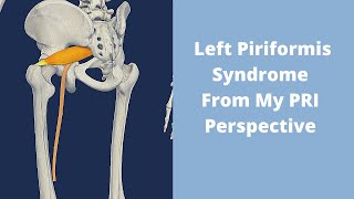 Understanding Left Piriformis Syndrome [upl. by Cohleen]