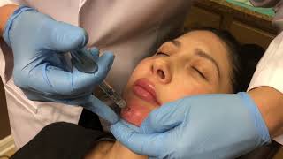 NonSurgical Chin Augmentation using Juvederm Voluma 3cc [upl. by Combe]