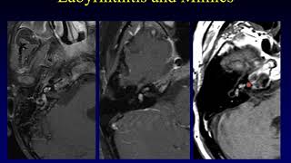 Temporal Bone Pathology 6 Hearing Loss Part 1 [upl. by Yesor]