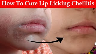 How To Cure Lip Licking Cheilitis [upl. by Nelyak980]