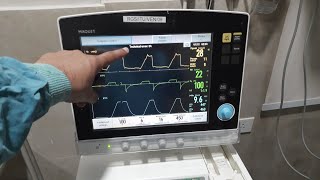 NIV Ventilator Settings  COVID19 Pneumonia ventilator settings in hindi [upl. by Onileva]