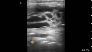 Baker’s Cyst  Ultrasound Image Interpretation [upl. by Constantine]