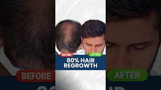 80 Hair Regrowth  Real review  Hair growth  hair fall  Hair loss Adon Hair Care viral shorts [upl. by Hcone]