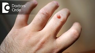 Natural methods to remove skin tags or warts at home  Dr Phanindra VV [upl. by Catrina]