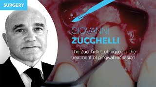 Prof Dr Giovanni Zucchelli’s technique for the treatment of gingival recession [upl. by Hilar]